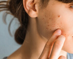 l'acné adulte