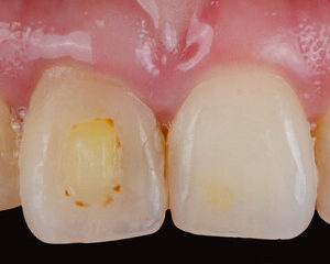 dents tachées par le vin rouge