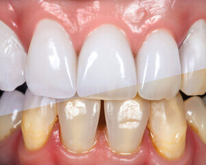 bienfaits du blanchiment dentaire