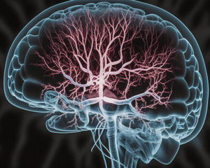 accident vasculaire cérébral