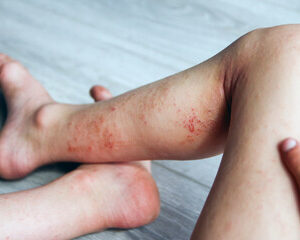  Allergies Alimentaires 