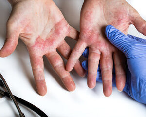 Allergies Alimentaires